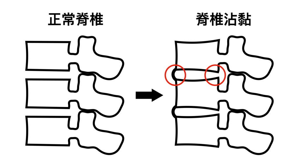 僵直性脊椎炎的脊椎沾黏