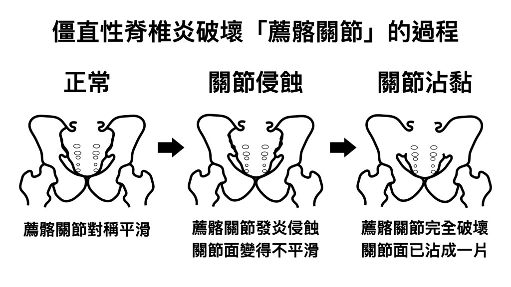 僵直性脊椎炎破壞薦髂關節的過程