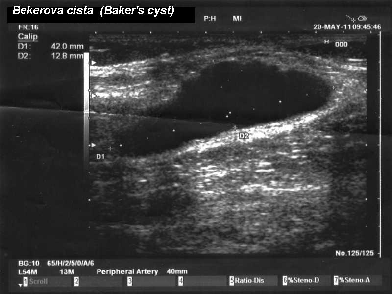 超音波下的貝克氏囊腫