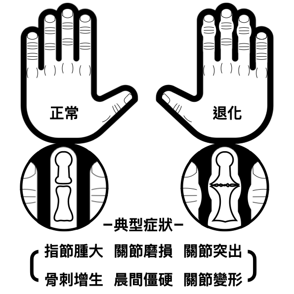 手的退化關節炎典型症狀有指結腫大、關節磨損、關節突出、骨刺增生、晨間僵硬與關節變形