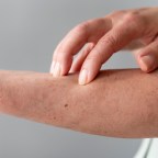 慢性蕁麻疹是過敏還是免疫異常？