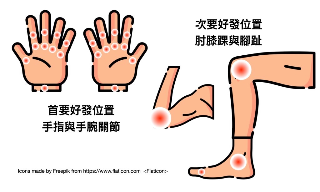類風濕性關節炎首要好發在手指與手腕關節，次要好發在手肘、膝蓋或腳踝。