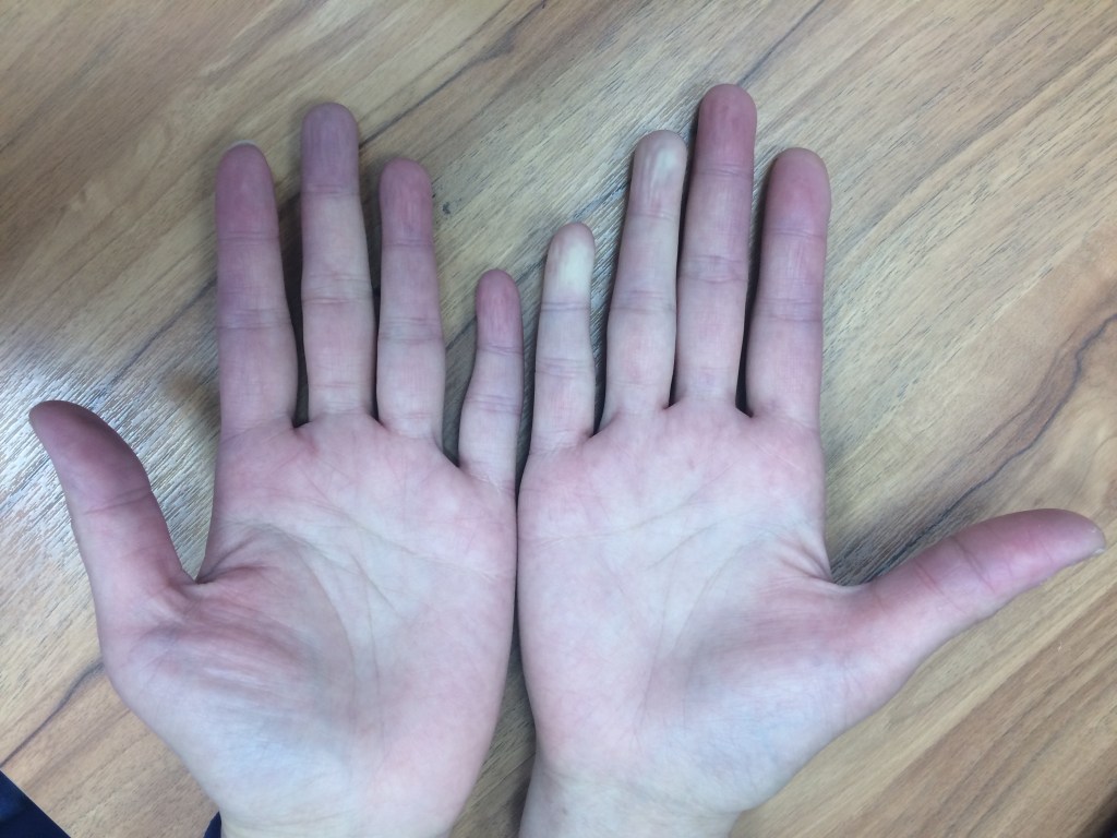 雷諾氏症的典型表現