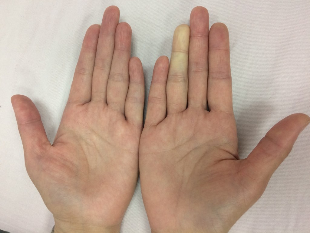 雷諾氏症的典型表現為遇冷指節發白或是發紫