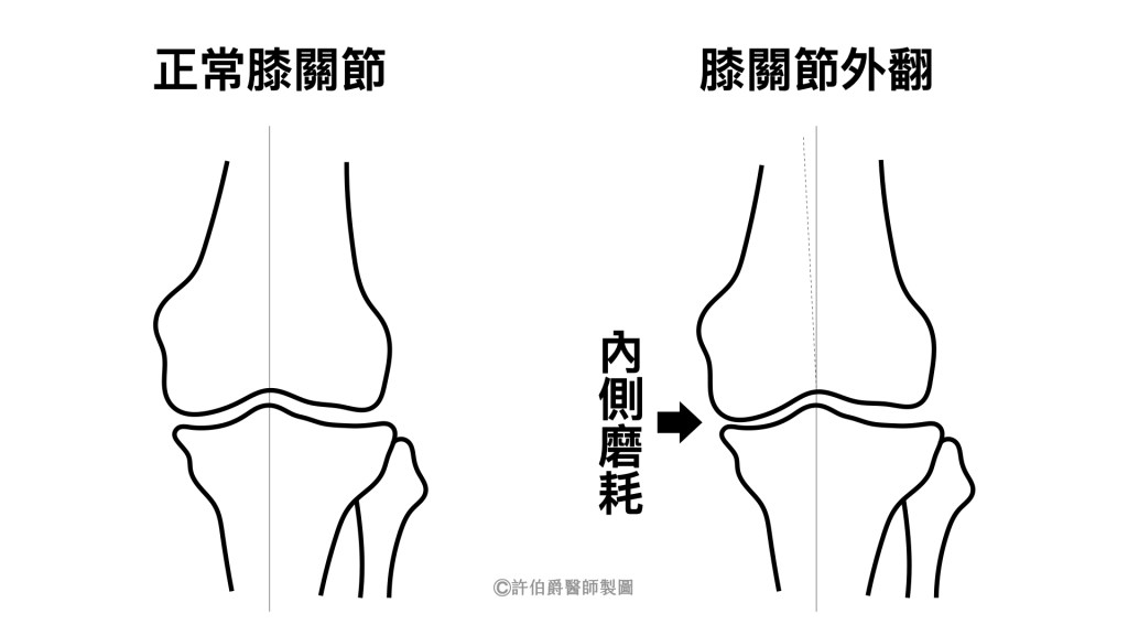 肥胖容易膝關節外翻造成內側磨耗，可能增加退化性關節炎的風險。