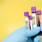 補體蛋白C3,C4在紅斑性狼瘡的病情上有什麼意義？