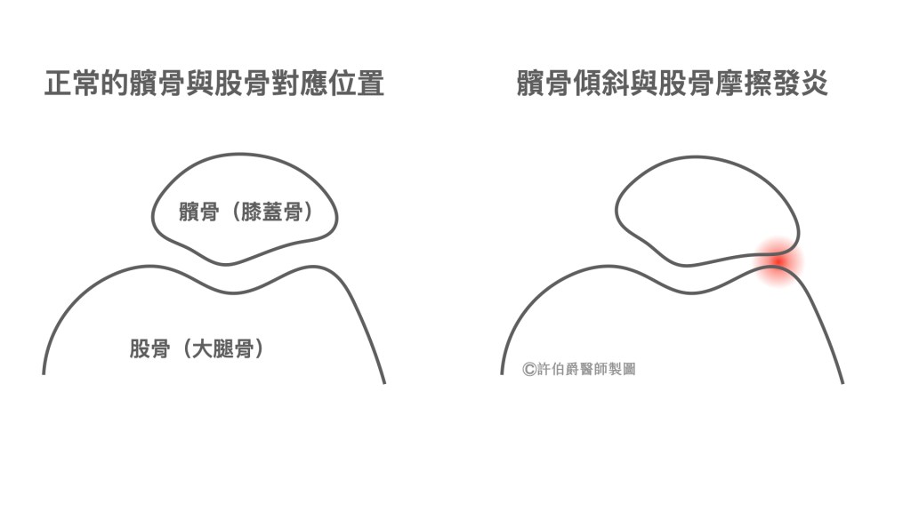 髕骨歪斜與股骨摩擦會造成膝關節處疼痛發炎（髕股骨疼痛症，或稱髕骨軟化症）。