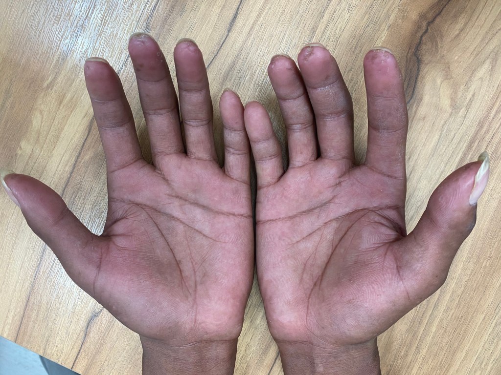 全身性硬化症或硬皮症可能在指尖出現小小的不容易癒合的傷口或小傷疤。