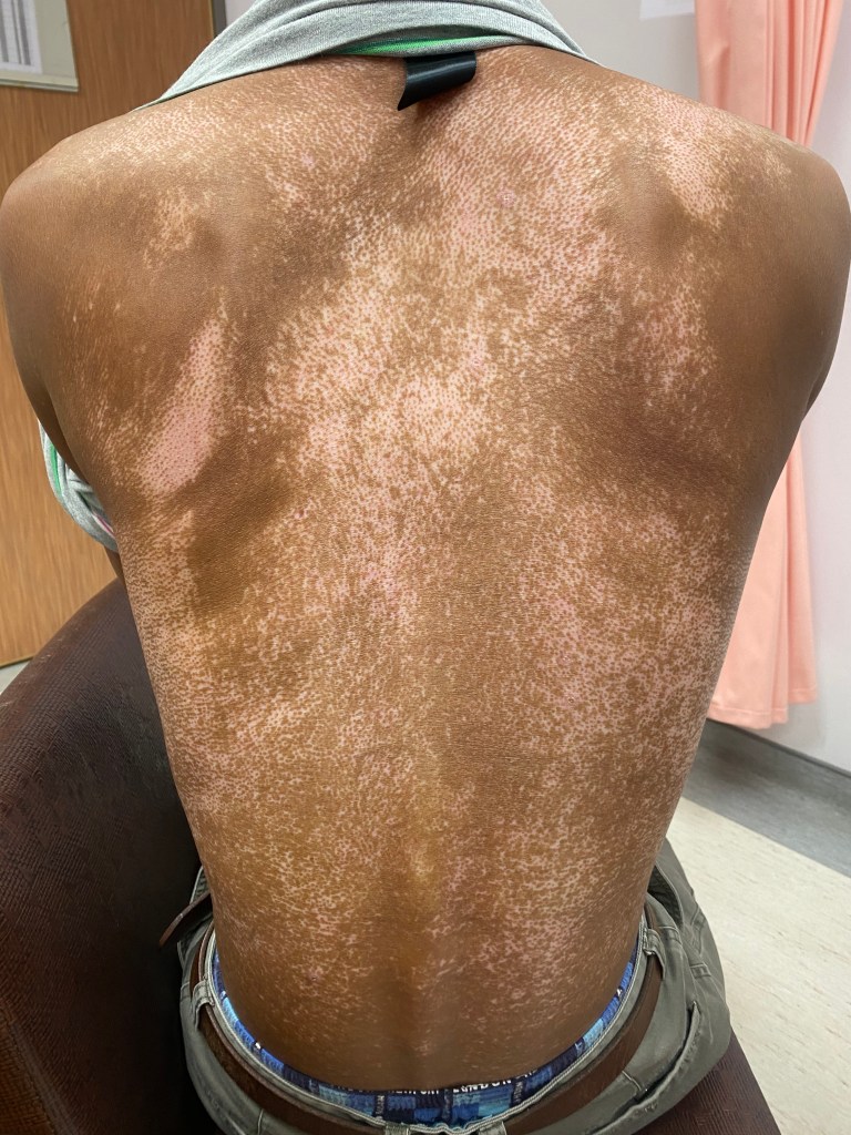 全身性硬化症或硬皮症的病人在皮膚可以出現膚色變黑且混雜著不勻稱的白色斑點