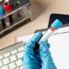 什麼是類風濕因子抗體／RF抗體／RA指數？跟病情有什麼關係呢？越高是不是越嚴重？