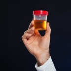 狼瘡腎炎的達標治療，蛋白尿應該多少才算達標呢？