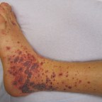 A型免疫球蛋白IgA造成的血管炎—四大症狀