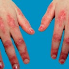 皮肌炎與多發性肌炎有什麼症狀，萬一肺纖維化可能致命！？