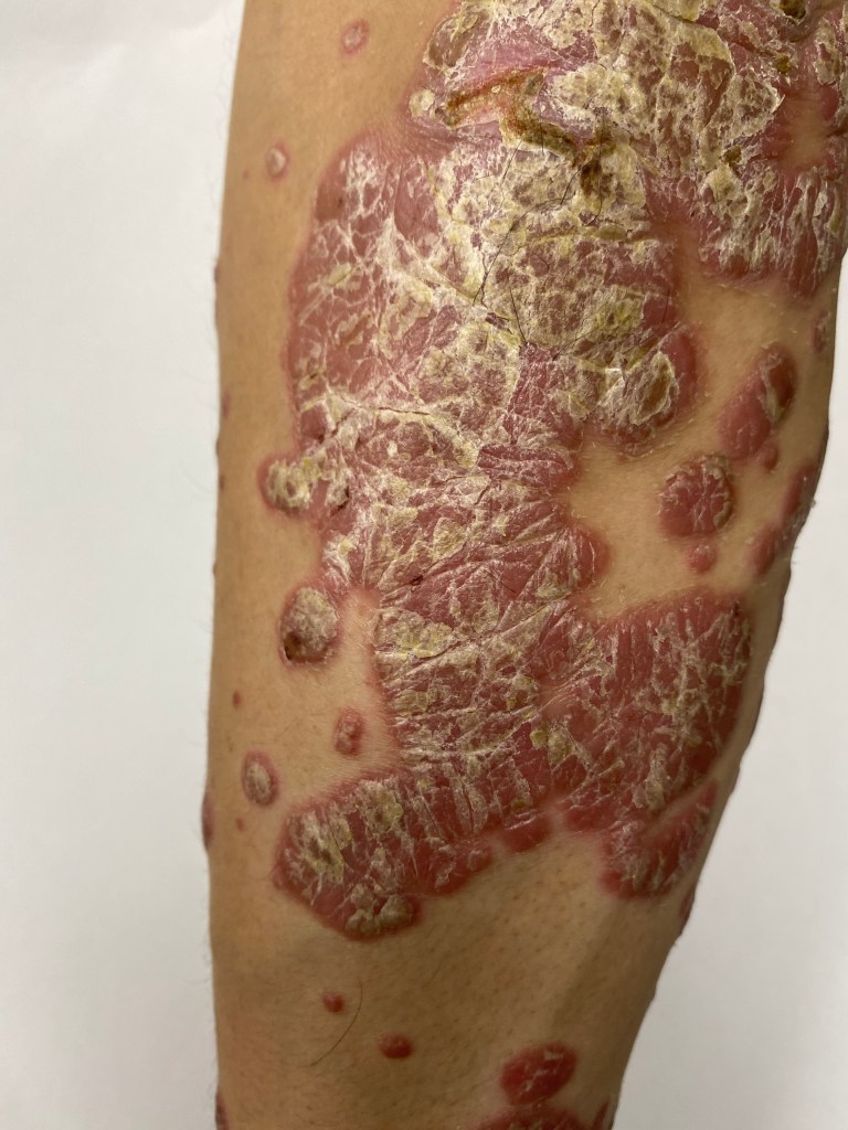 典型的斑塊型乾癬皮膚病灶