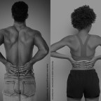 僵直性脊椎炎是男性多還是女性多呢？