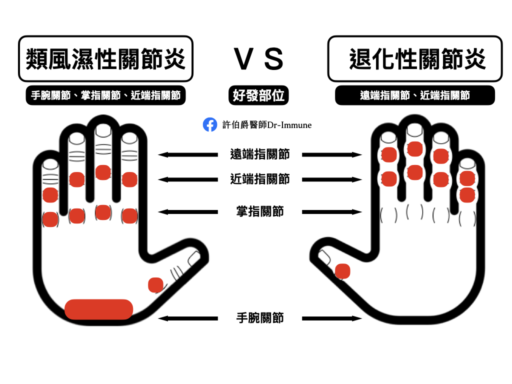 退化性關節炎與類風濕性關節炎好發部位比較 ＠許伯爵醫師 Dr-Immune