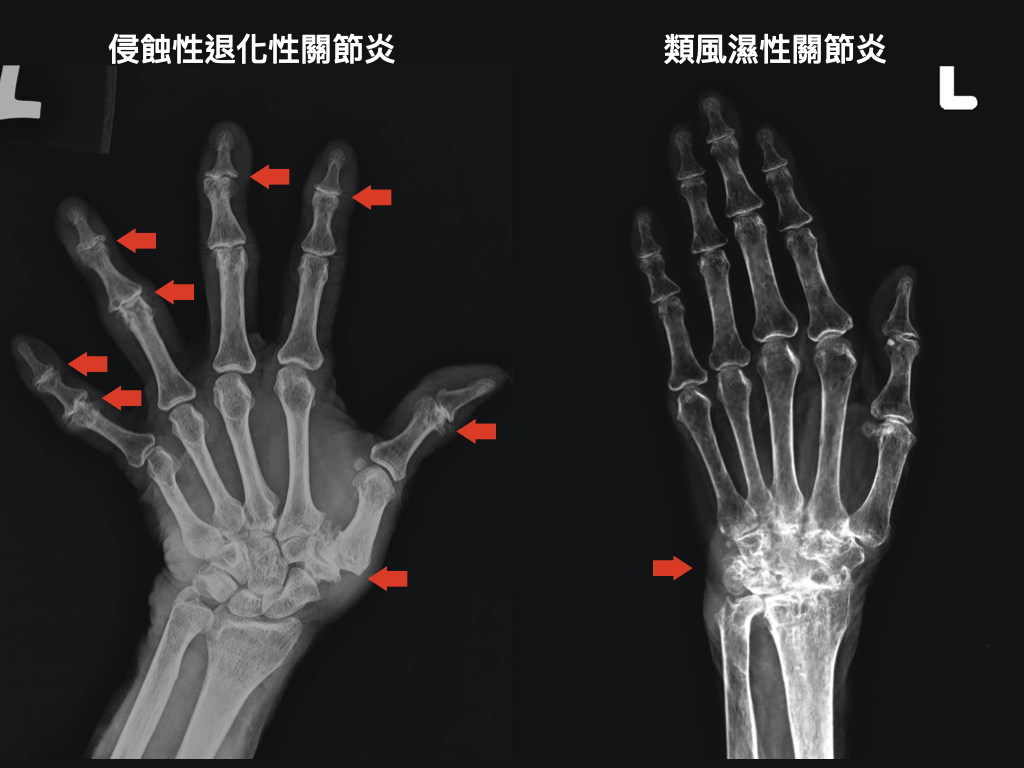 侵蝕性退化性關節炎的侵蝕位置與侵蝕方式都跟類風濕性關節炎不同 ＠許伯爵醫師  Dr-Immune