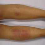 結節性紅斑是紅斑性狼瘡嗎？為什麼會長結節性紅斑？